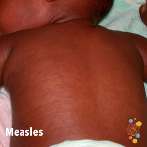 Measles rash on the back of a young baby with dark skin.