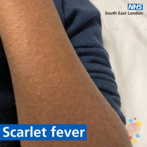 Arm of a child with small bumps on it - which might be one of the symptoms for scarlet fever