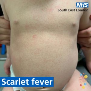 Chest of a child with a rash that looks like small, raised bumps and can be one of the symptoms of scarlet fever