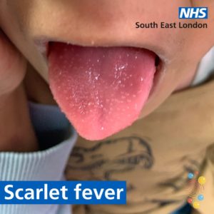 A child showing their tongue, with a white coating on it - which might be one of the symptoms for scarlet fever